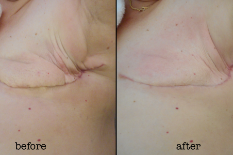 Tight Mastectomy