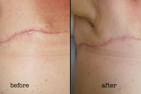 New Mastectomy