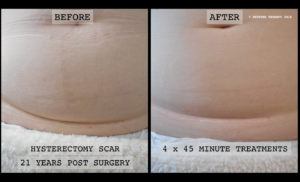 hysterectomy scar before and after