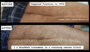 COMPOUND FRACTURE SCAR BEFORE AND AFTER